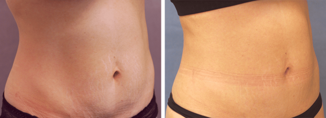 CoolSculpting result at ARTIS Institute - Dr. Sarraga in Aventura, FL