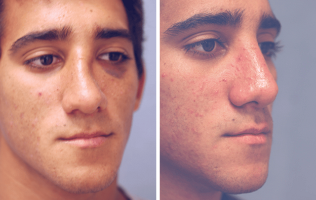 Rhinoplasty result at ARTIS Institute - Dr. Sarraga in Aventura, FL