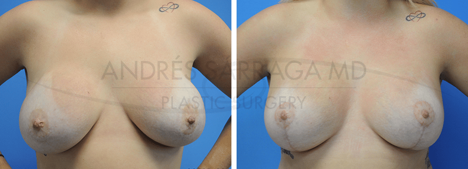 ARTIS Institute - Dr. Sarraga breast lift result — Aventura, FL