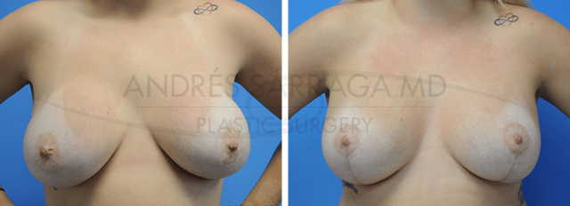 Breast Lift result at ARTIS Institute - Dr. Sarraga in Aventura, FL