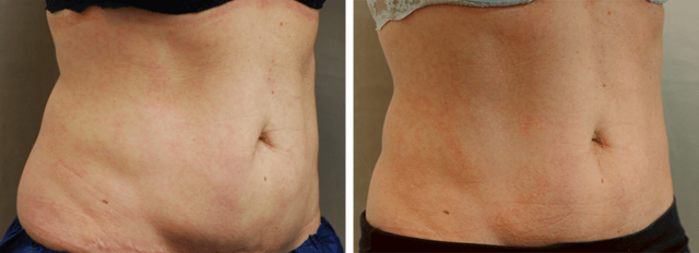 CoolSculpting result at ARTIS Institute - Dr. Sarraga in Aventura, FL