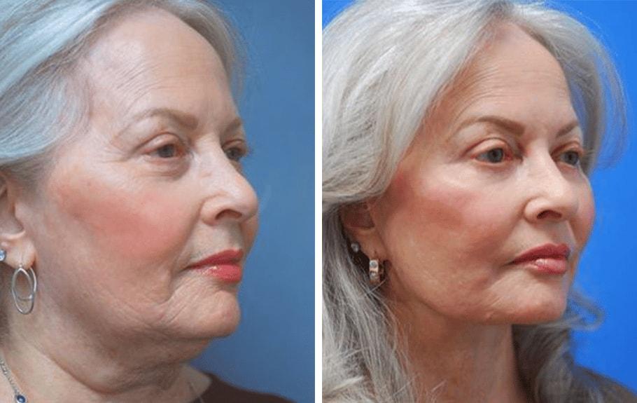 ARTIS Institute - Dr. Sarraga facelift result — Aventura, FL