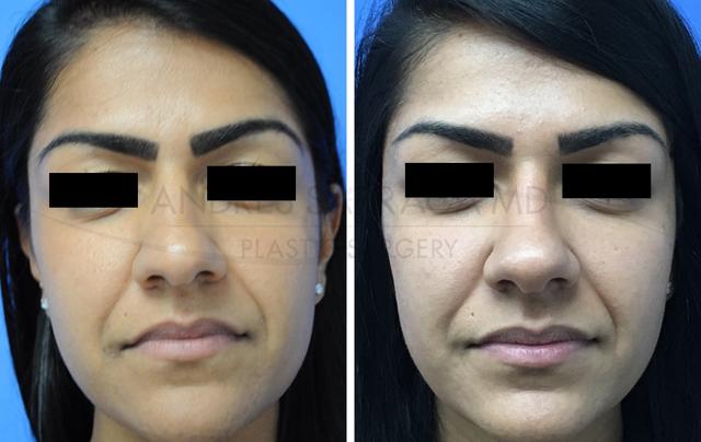 Rhinoplasty result at ARTIS Institute - Dr. Sarraga in Aventura, FL