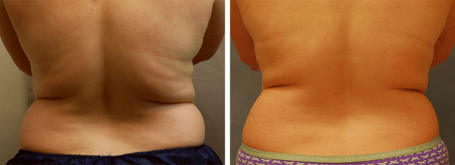CoolSculpting result at ARTIS Institute - Dr. Sarraga in Aventura, FL