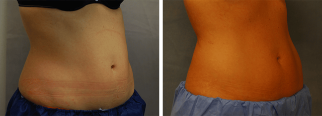 CoolSculpting result at ARTIS Institute - Dr. Sarraga in Aventura, FL
