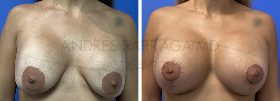 ARTIS Institute - Dr. Sarraga breast augmentation result — Aventura, FL