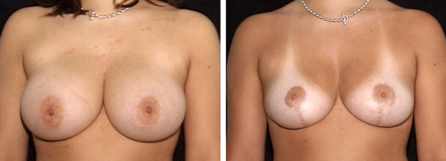 Breast Reduction result at ARTIS Institute - Dr. Sarraga in Aventura, FL