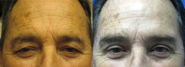 Blepharoplasty result at ARTIS Institute - Dr. Sarraga in Aventura, FL