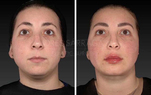 Lip Filler result at ARTIS Institute - Dr. Sarraga in Aventura, FL