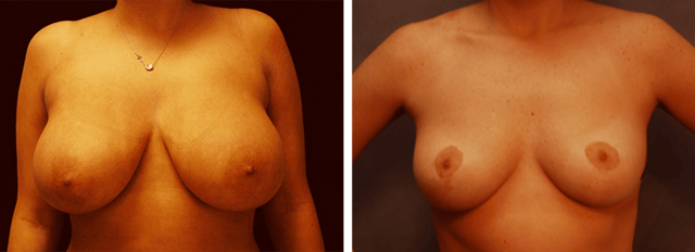 Breast Reduction result at ARTIS Institute - Dr. Sarraga in Aventura, FL