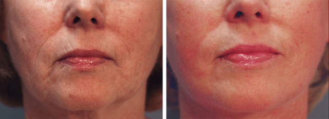 Laser Skin Resurfacing result at ARTIS Institute - Dr. Sarraga in Aventura, FL