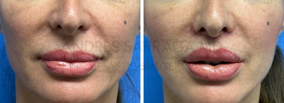 ARTIS Institute - Dr. Sarraga lip lift result — Aventura, FL