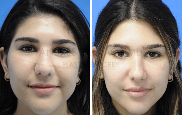 Rhinoplasty result at ARTIS Institute - Dr. Sarraga in Aventura, FL