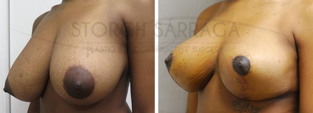 Breast Reduction result at ARTIS Institute - Dr. Sarraga in Aventura, FL