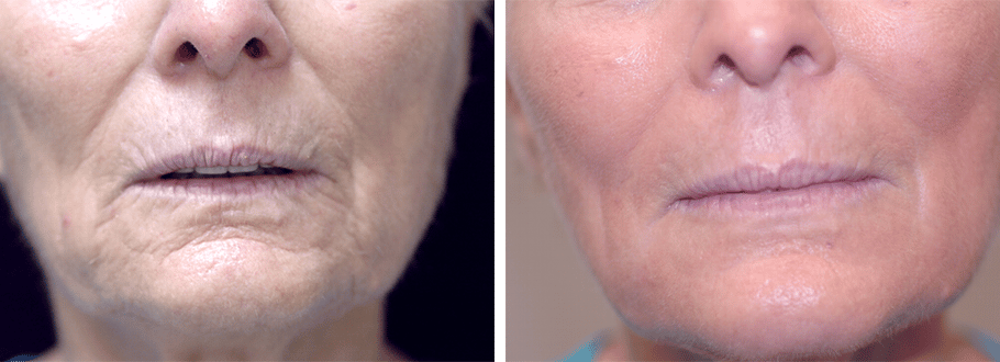 ARTIS Institute - Dr. Sarraga laser treatment result — Aventura, FL
