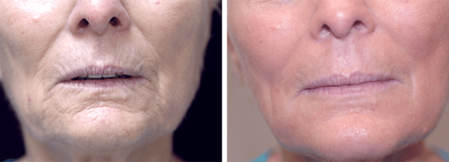 Laser Skin Resurfacing result at ARTIS Institute - Dr. Sarraga in Aventura, FL