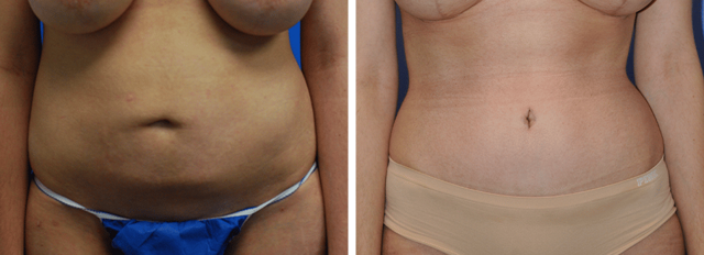 Tummy Tuck result at ARTIS Institute - Dr. Sarraga in Aventura, FL