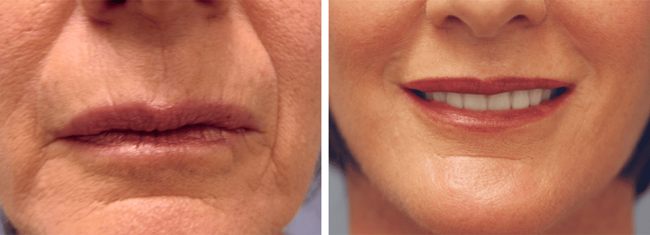 ARTIS Institute - Dr. Sarraga laser treatment result — Aventura, FL