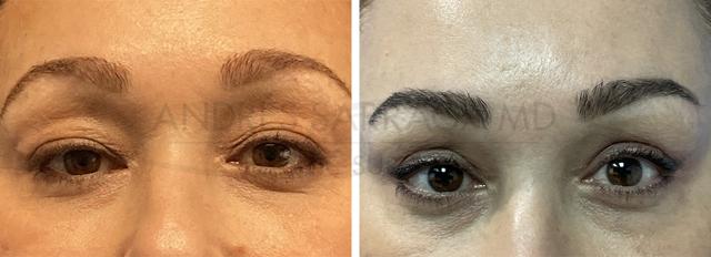Blepharoplasty result at ARTIS Institute - Dr. Sarraga in Aventura, FL