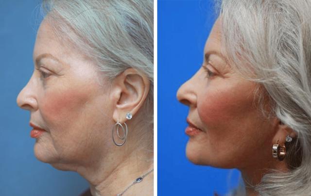 Facelift result at ARTIS Institute - Dr. Sarraga in Aventura, FL