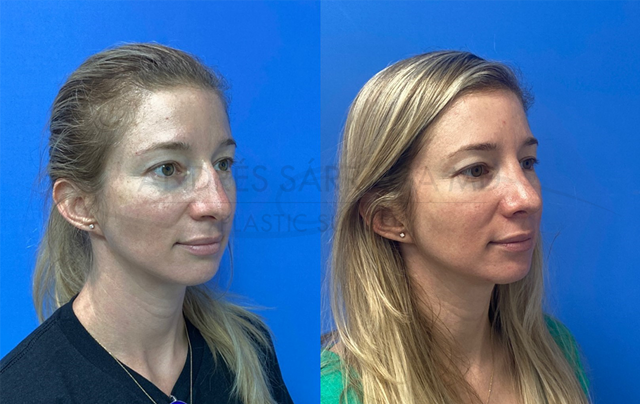 Rhinoplasty result at ARTIS Institute - Dr. Sarraga in Aventura, FL