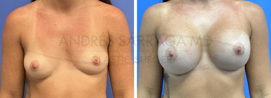 ARTIS Institute - Dr. Sarraga breast augmentation result — Aventura, FL