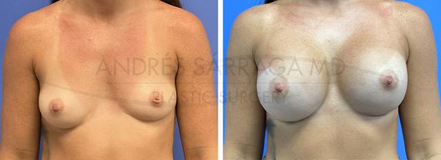 Breast Augmentation result at ARTIS Institute - Dr. Sarraga in Aventura, FL