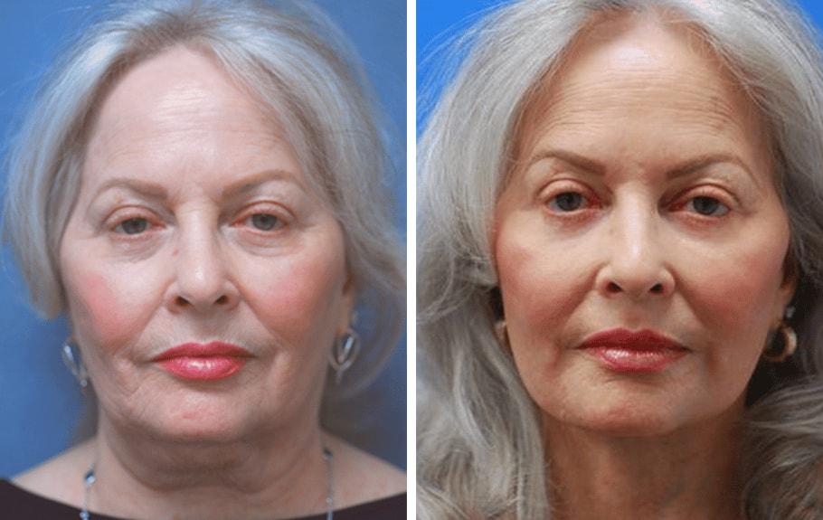 ARTIS Institute - Dr. Sarraga facelift result — Aventura, FL