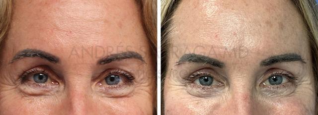 Blepharoplasty result at ARTIS Institute - Dr. Sarraga in Aventura, FL