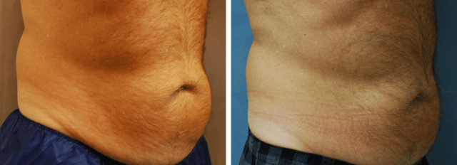 CoolSculpting result at ARTIS Institute - Dr. Sarraga in Aventura, FL