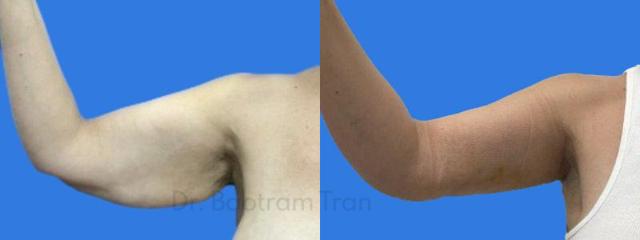 Arm Lift result at ARTIS Institute - Dr. Sarraga in Aventura, FL