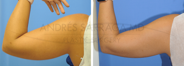 CoolSculpting result at ARTIS Institute - Dr. Sarraga in Aventura, FL