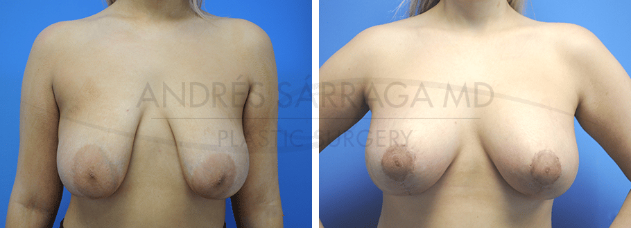 ARTIS Institute - Dr. Sarraga breast augmentation result — Aventura, FL