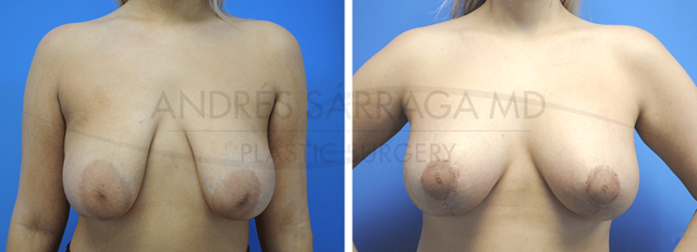 Breast Augmentation result at ARTIS Institute - Dr. Sarraga in Aventura, FL
