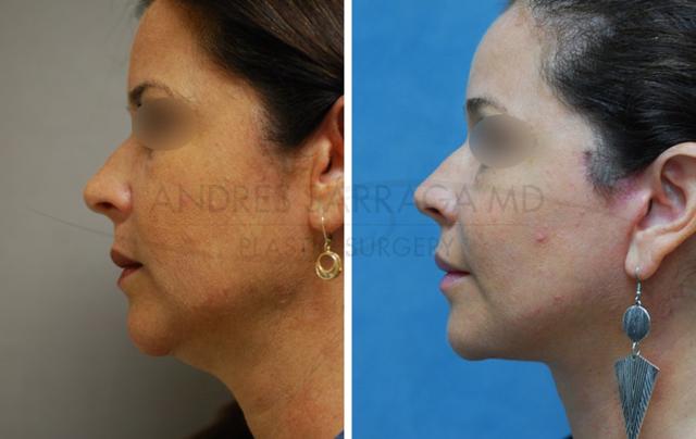 Facelift result at ARTIS Institute - Dr. Sarraga in Aventura, FL