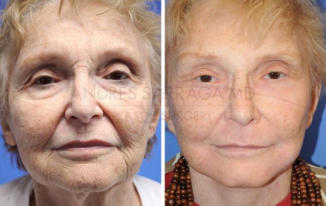 Facelift result at ARTIS Institute - Dr. Sarraga in Aventura, FL