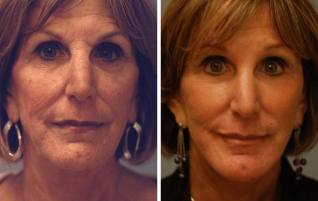 Mini Facelift result at ARTIS Institute - Dr. Sarraga in Aventura, FL
