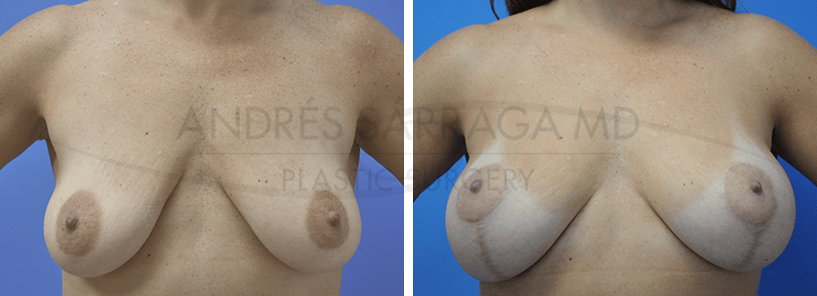 ARTIS Institute - Dr. Sarraga breast augmentation result — Aventura, FL