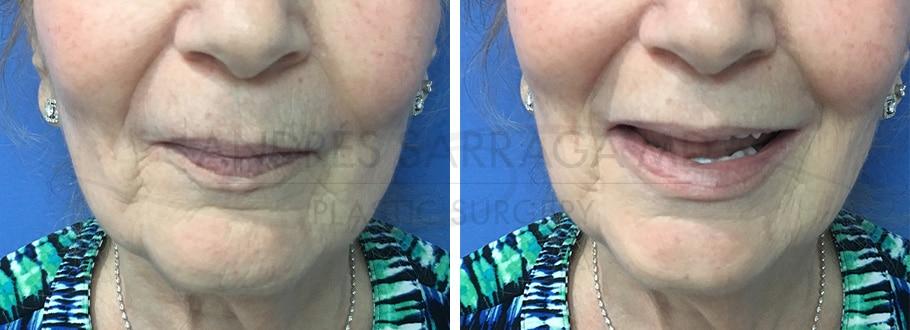 ARTIS Institute - Dr. Sarraga lip lift result — Aventura, FL