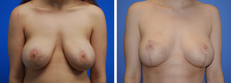 ARTIS Institute - Dr. Sarraga breast lift result — Aventura, FL