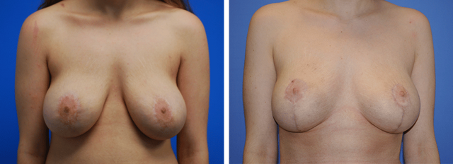 Breast Lift result at ARTIS Institute - Dr. Sarraga in Aventura, FL