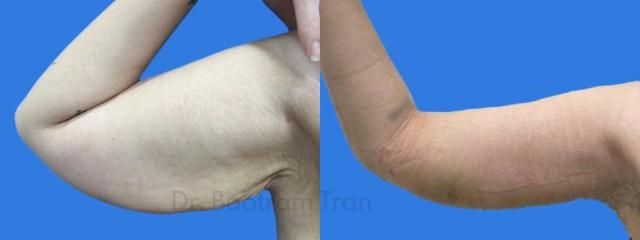 Arm Lift result at ARTIS Institute - Dr. Sarraga in Aventura, FL