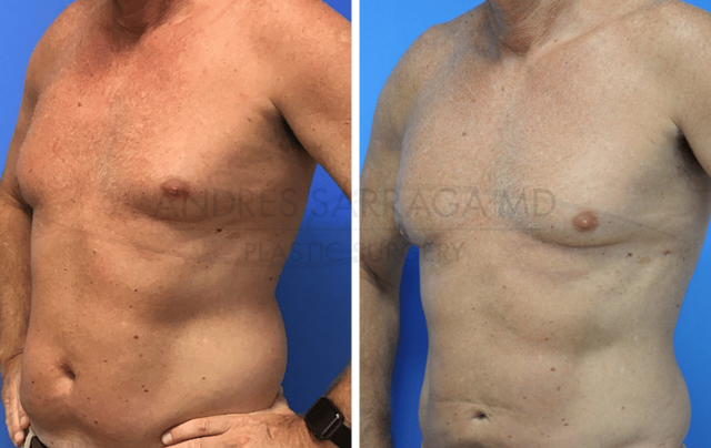 Liposuction result at ARTIS Institute - Dr. Sarraga in Aventura, FL
