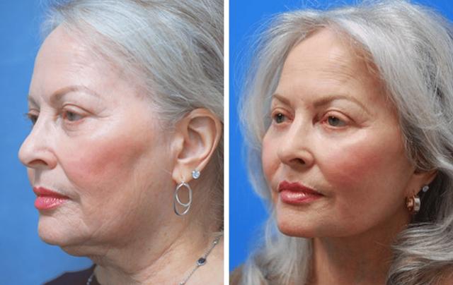 Mini Facelift result at ARTIS Institute - Dr. Sarraga in Aventura, FL
