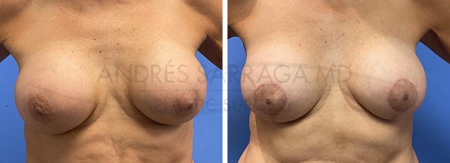 ARTIS Institute - Dr. Sarraga breast lift result — Aventura, FL