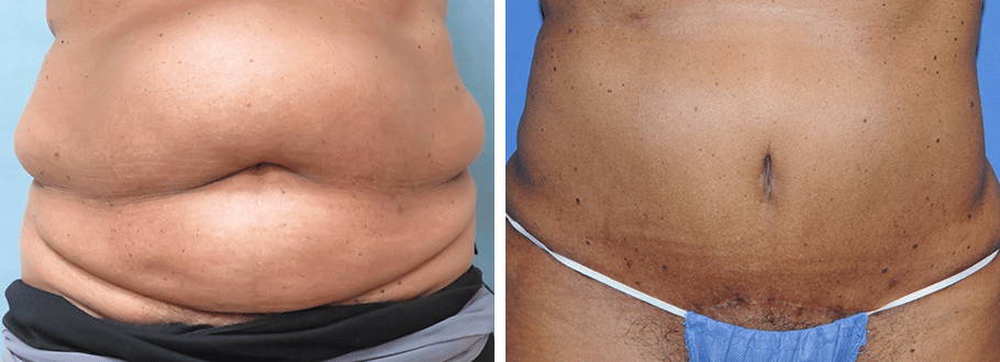 ARTIS Institute - Dr. Sarraga tummy tuck result — Aventura, FL