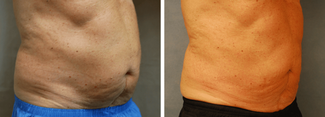 CoolSculpting result at ARTIS Institute - Dr. Sarraga in Aventura, FL