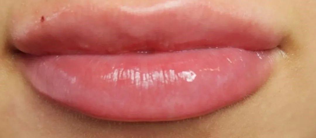 River Aesthetics lip filler after — Eagle, ID