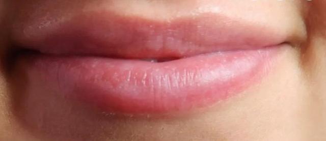 Juvederm before at River Aesthetics in Eagle, ID
