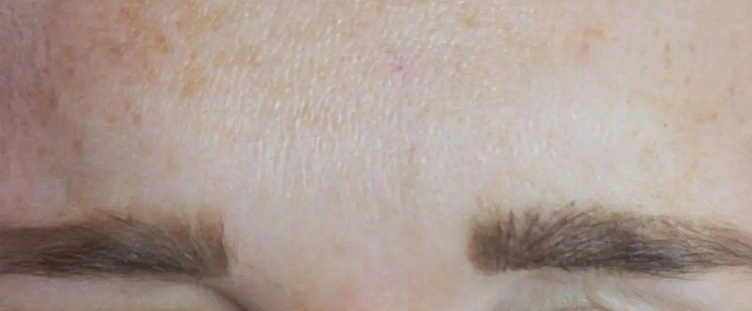 River Aesthetics botox after — Eagle, ID